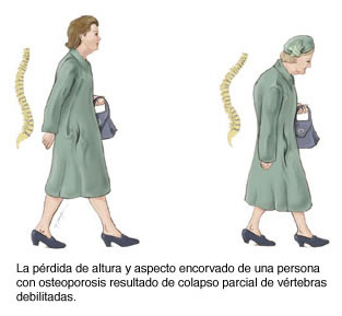 Osteoporosis en mujeres Osteoporosis en mujeres