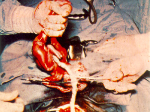 Aborto por cesárea