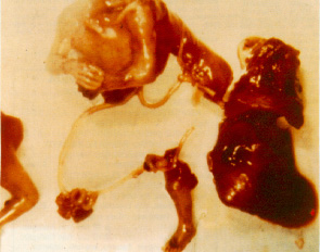Aborto por dilatación y curetaje