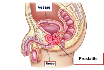 Prostate Inflammation