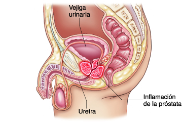 Próstata inflamada.