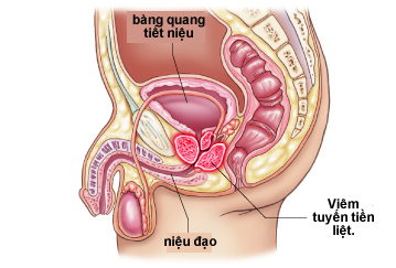 Viêm tuyến tiền liệt.